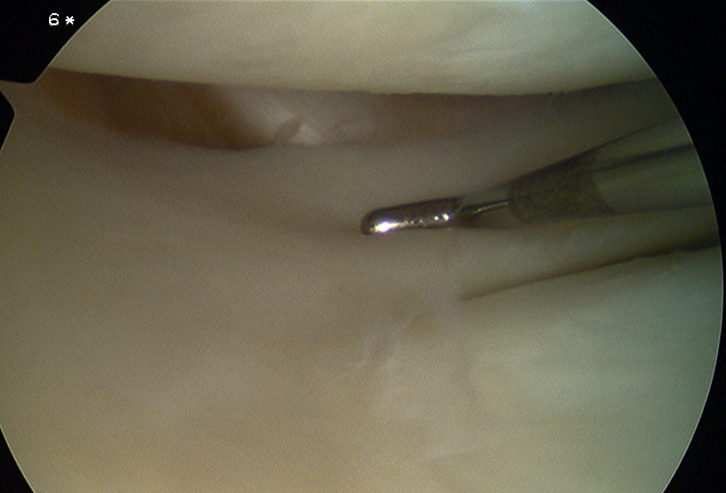 Popliteus tendon intra-articular